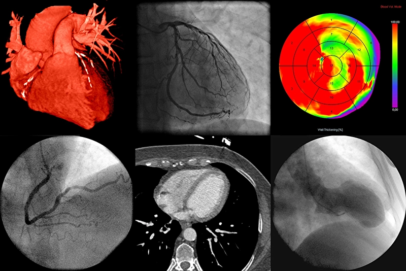 Cardiac PET imaging