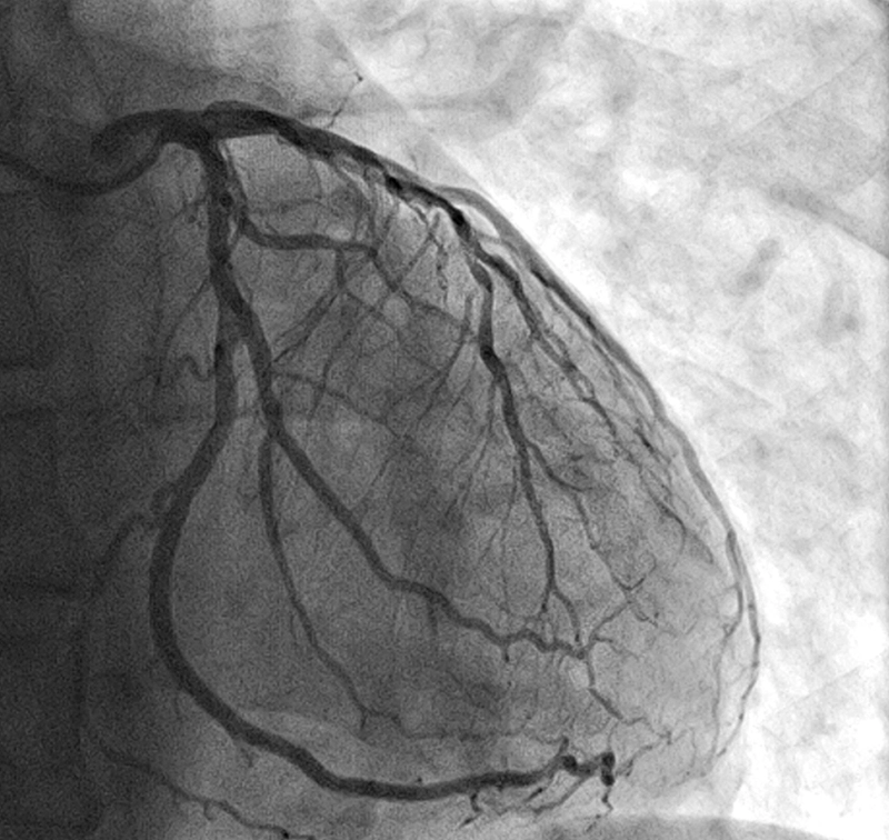 Interventional cardiology