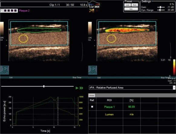 Parametric image of the perfused area of a carotid plaque and the respective numeric values