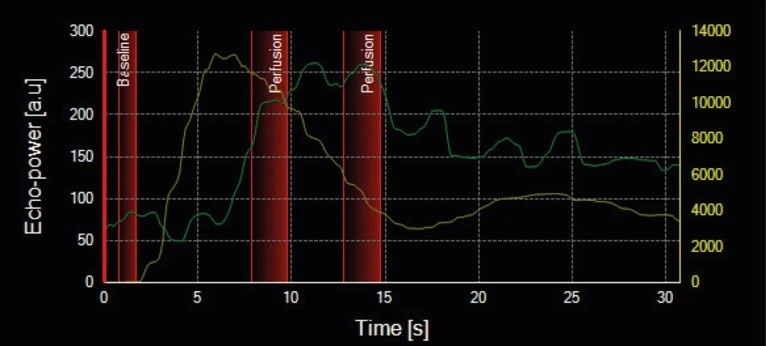 Time windows selection on dual-scale graph, showing TIC from plaque and vascular lumen